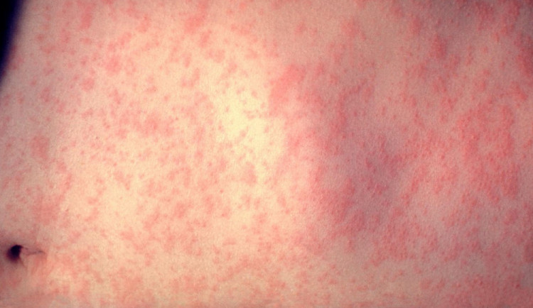 Přes pět set zdravotníků z Olomouckého kraje bude očkováno proti spalničkám